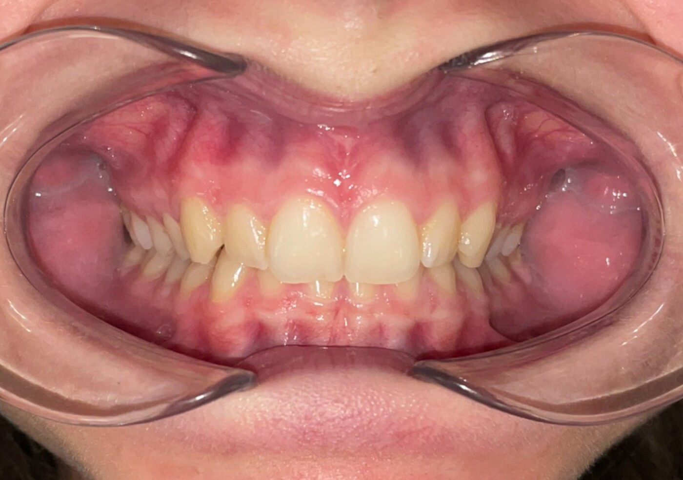 INVISALIGN ŞEFFAF PLAK Tedavi öncesi