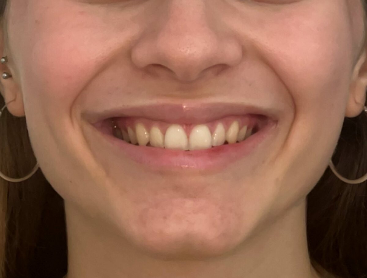 INVISALIGN ŞEFFAF PLAK Tedavi sonrası